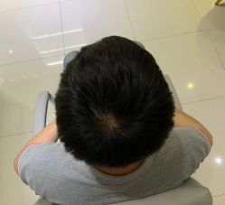 -大麦微针植发全国连锁