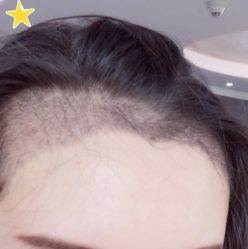 -大麦微针植发丨全国连锁