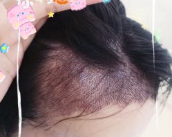 -大麦微针植发全国连锁