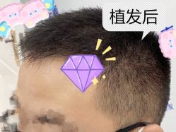 -大麦微针植发全国连锁