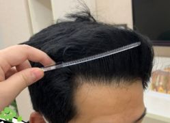 -大麦微针植发丨全国连锁