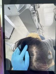 -大麦微针植发丨全国连锁