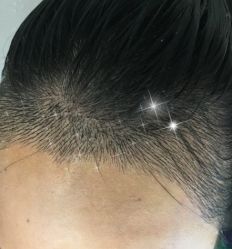 -大麦微针植发全国连锁