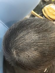 -碧莲盛·不剃发植发