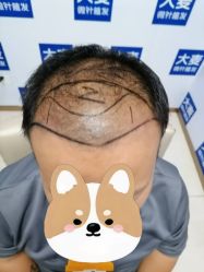 体验前-大麦微针植发丨全国连锁