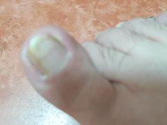 -祖传修脚甲沟炎灰指甲鸡眼