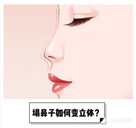 塌鼻子如何变立体？【案例详解】