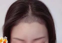 -大麦微针植发丨全国连锁