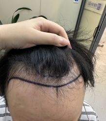 -大麦微针植发全国连锁