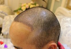 -大麦微针植发丨全国连锁