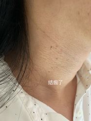 -美丽人生祛斑扁平疣汗管瘤中心