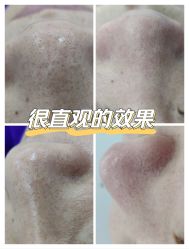 体验前-蕾特恩专业祛痘·皮肤管理