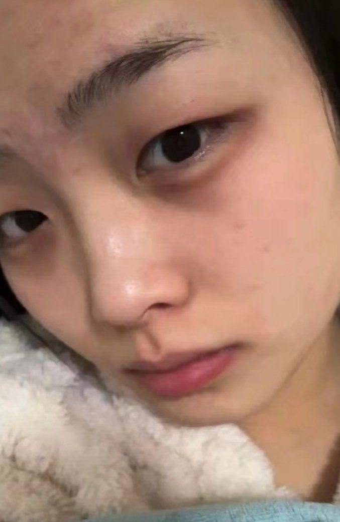 黑眼圈💉的滞后性也太