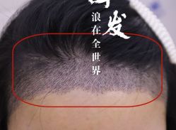 -大麦微针植发全国连锁