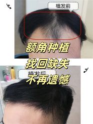 -大麦微针植发全国连锁