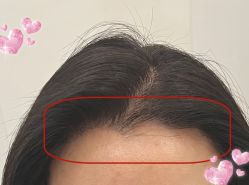 -大麦微针植发全国连锁