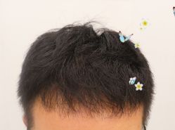 -大麦微针植发全国连锁