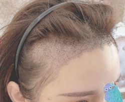 -大麦微针植发丨全国连锁