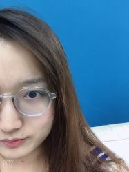 体验后-More摩尔医美の注射线雕光电中心