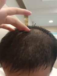 点击看大图 -碧莲盛·不剃发植发