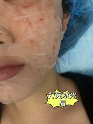 体验后-agge蛋白医美