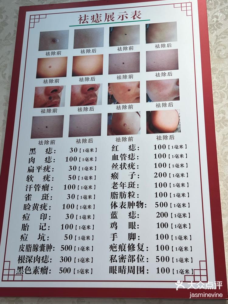 药物点痣初体验