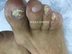 -德哥灰指甲脚气甲沟炎跖疣护理