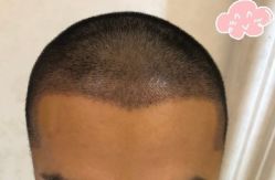 -大麦微针植发丨全国连锁