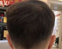 -大麦微针植发全国连锁