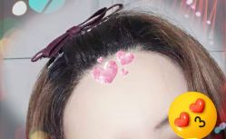 -大麦微针植发全国连锁