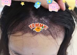 -大麦微针植发全国连锁