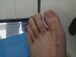 点击看大图 -派恩宜灰指甲鸡眼嵌甲手足癣