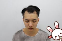 -大麦微针植发丨全国连锁