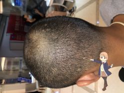 -大麦微针植发丨全国连锁