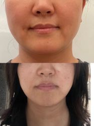 体验前-大华韩艺整形美容医院