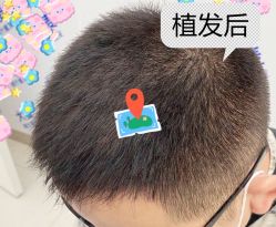 -大麦微针植发全国连锁