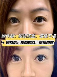 -广州健丽·去眼袋医疗美容机构
