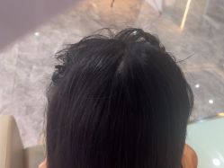 -碧莲盛·不剃发植发