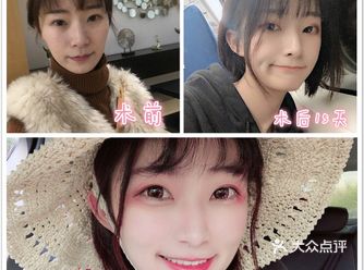 线雕的提升原理是什么？