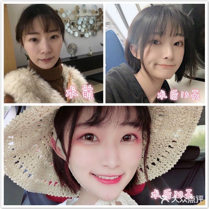 线雕的提升原理是什么？