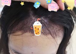 -大麦微针植发全国连锁