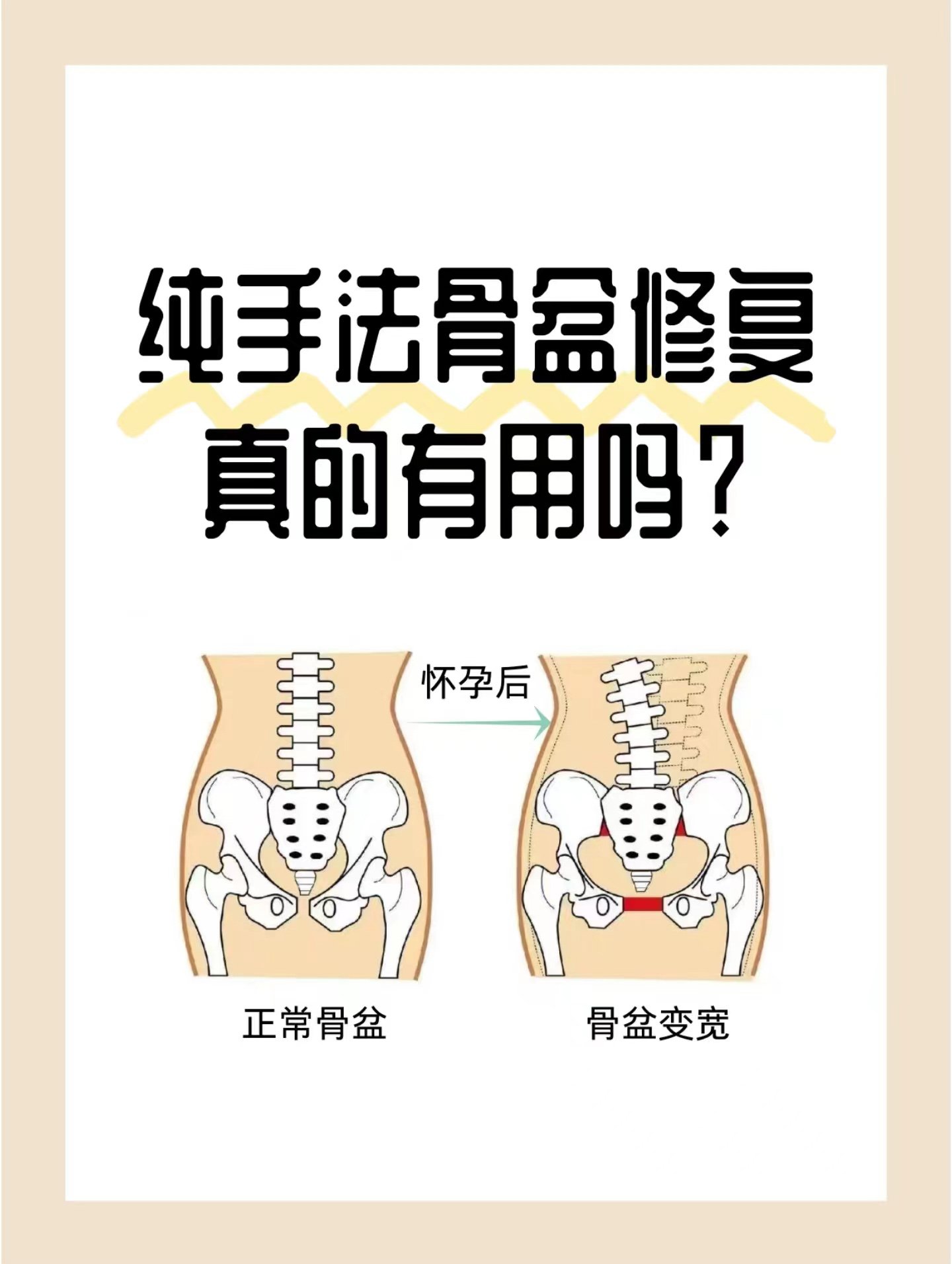 骨盆修复最佳时间图片