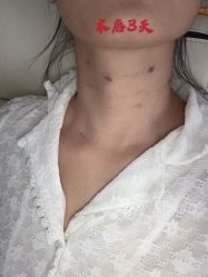 -大麦微针植发全国连锁