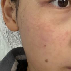 体验后-深圳米兰柏羽医疗美容医院