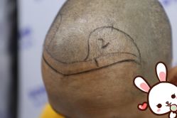 点击看大图 -大麦微针植发丨全国连锁