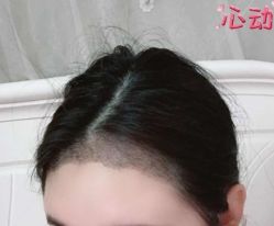 -大麦微针植发丨全国连锁