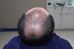 点击看大图 -大麦微针植发全国连锁