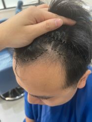 -大麦微针植发全国连锁