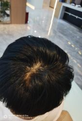-碧莲盛·不剃发植发