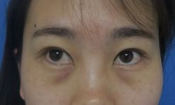 -天津健丽·去眼袋医疗美容机构